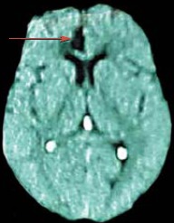 Brain Defect